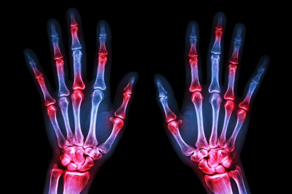 گنٹھیا آرتھرائٹس کی ایک قسم