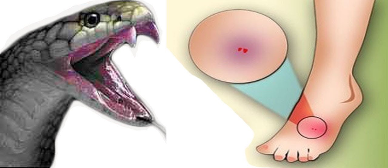 بچھو سانپ منہ ڈسی