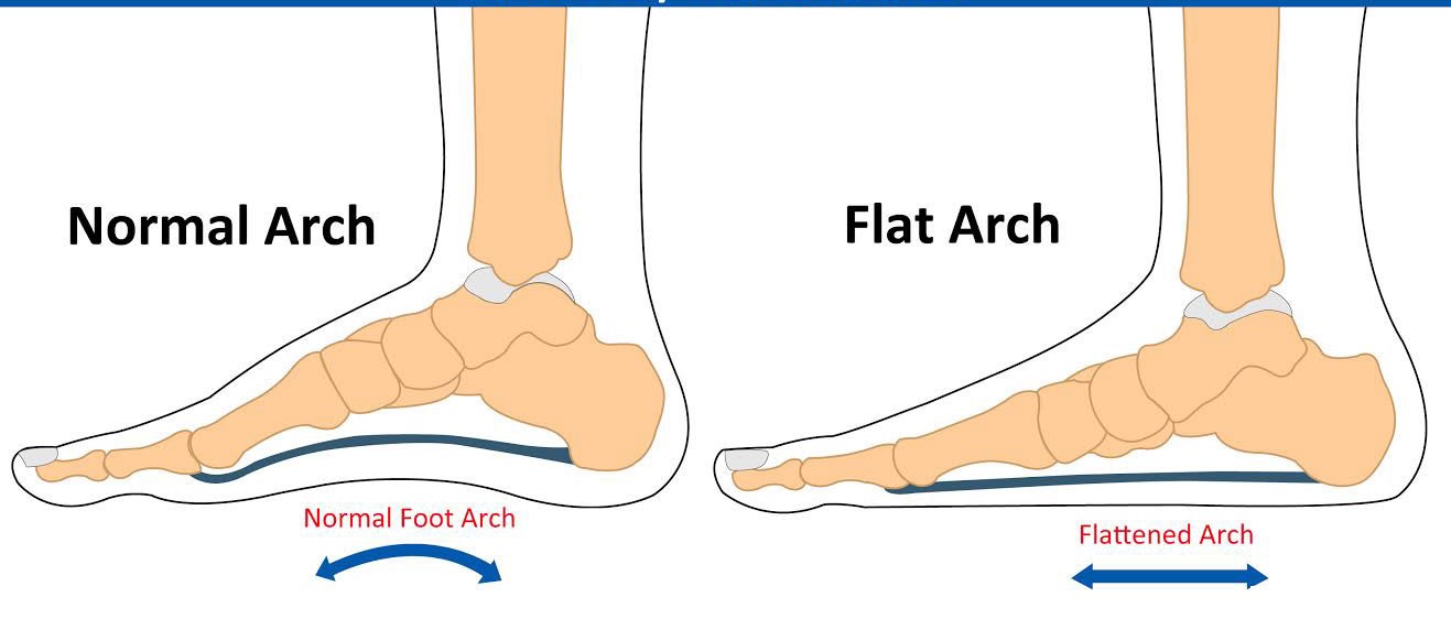 پائوں ہموار درد پیدل