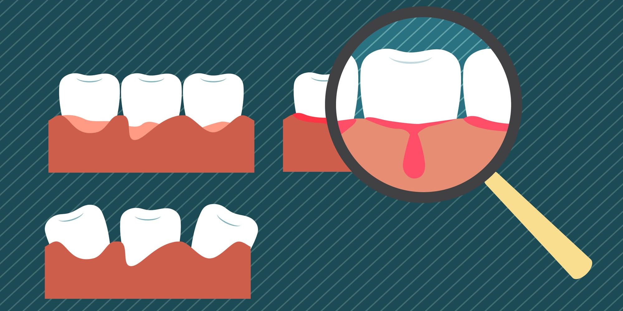 بیکٹیریا فلا سنگ پلاک ٹاٹر