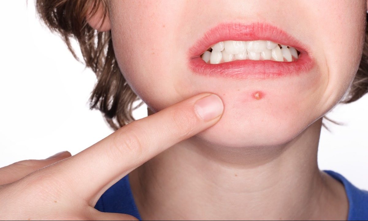 معدہ خراب‘ چہرے پردانے