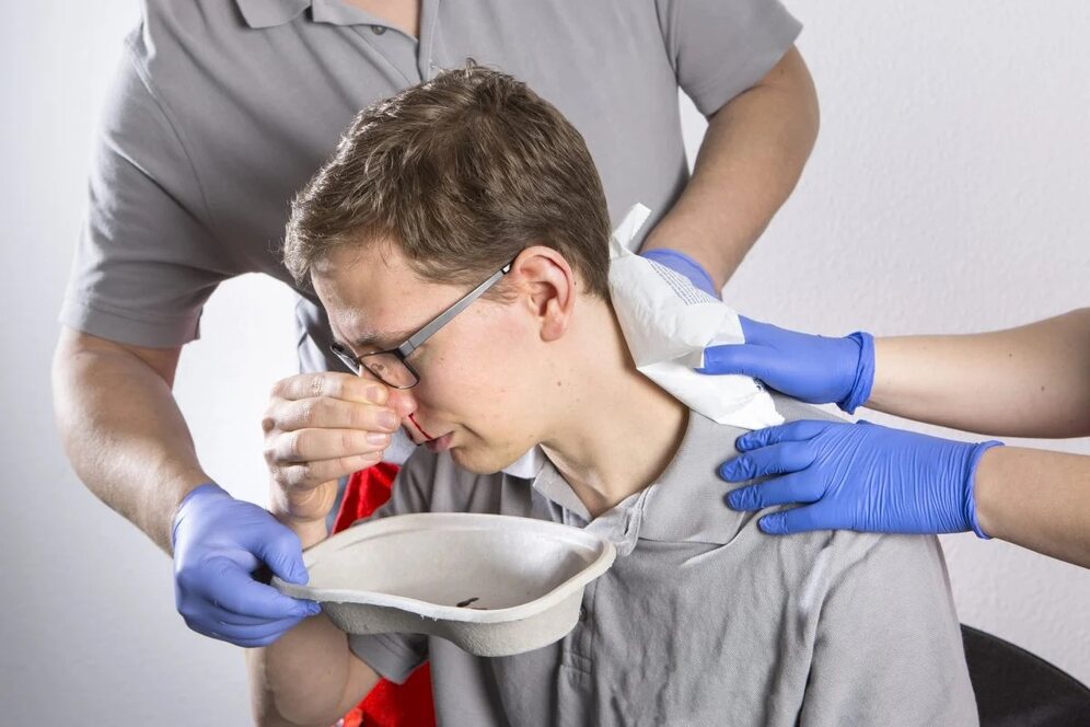 نکسیر کو کیسے روکیں