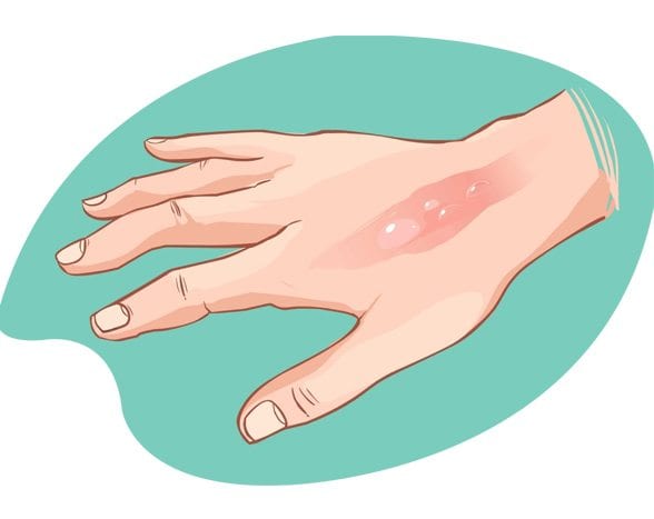   جلی ہوئی جلد اورٹوتھ پیسٹ