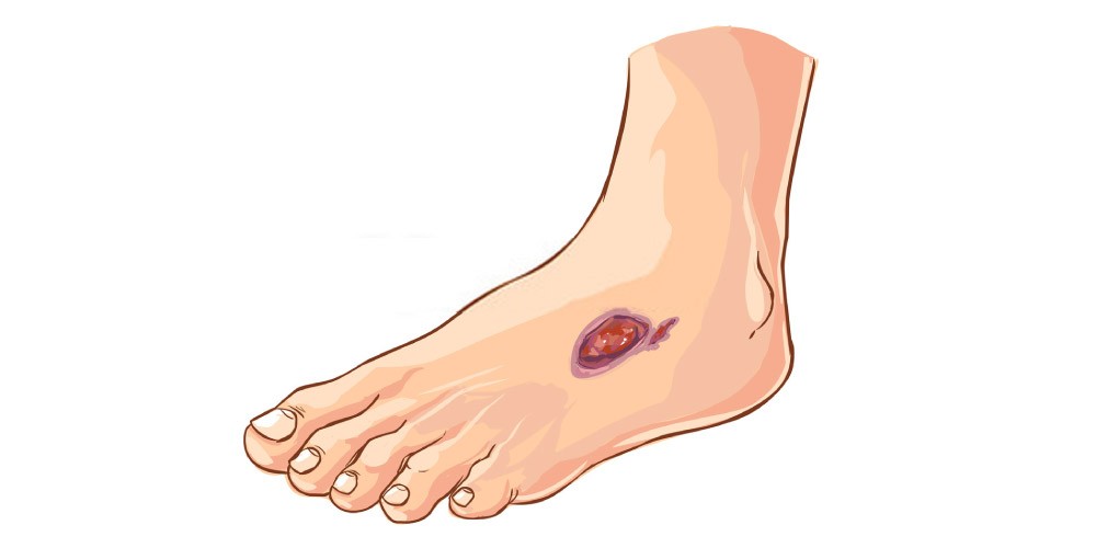 زخم دیرسے بھرنے کا مسئلہ