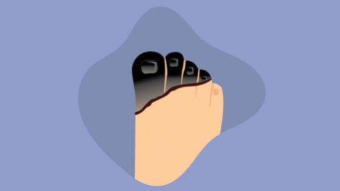 گینگرین وجوہات علامات تشخیص اورعلاج