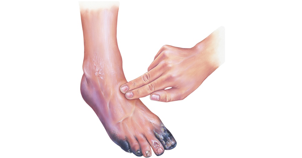 گینگرین کی اقسام خشک تر فارنیئر