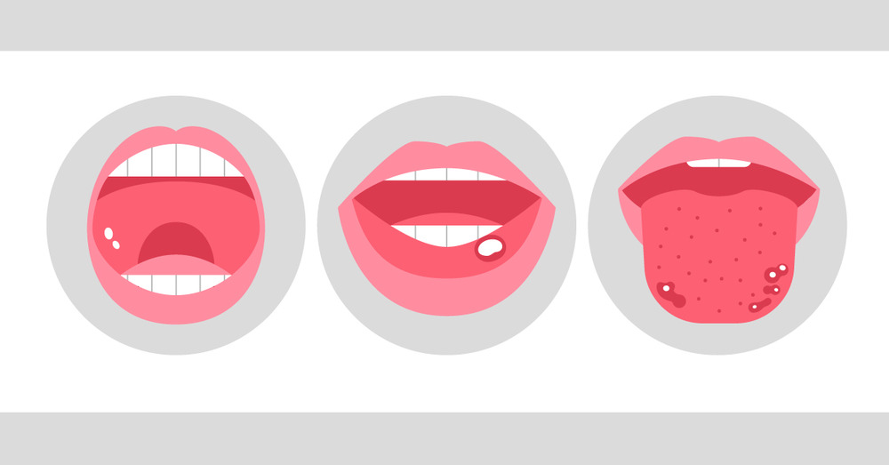 منہ میں چھالے, منہ کے السر-شفانیوز