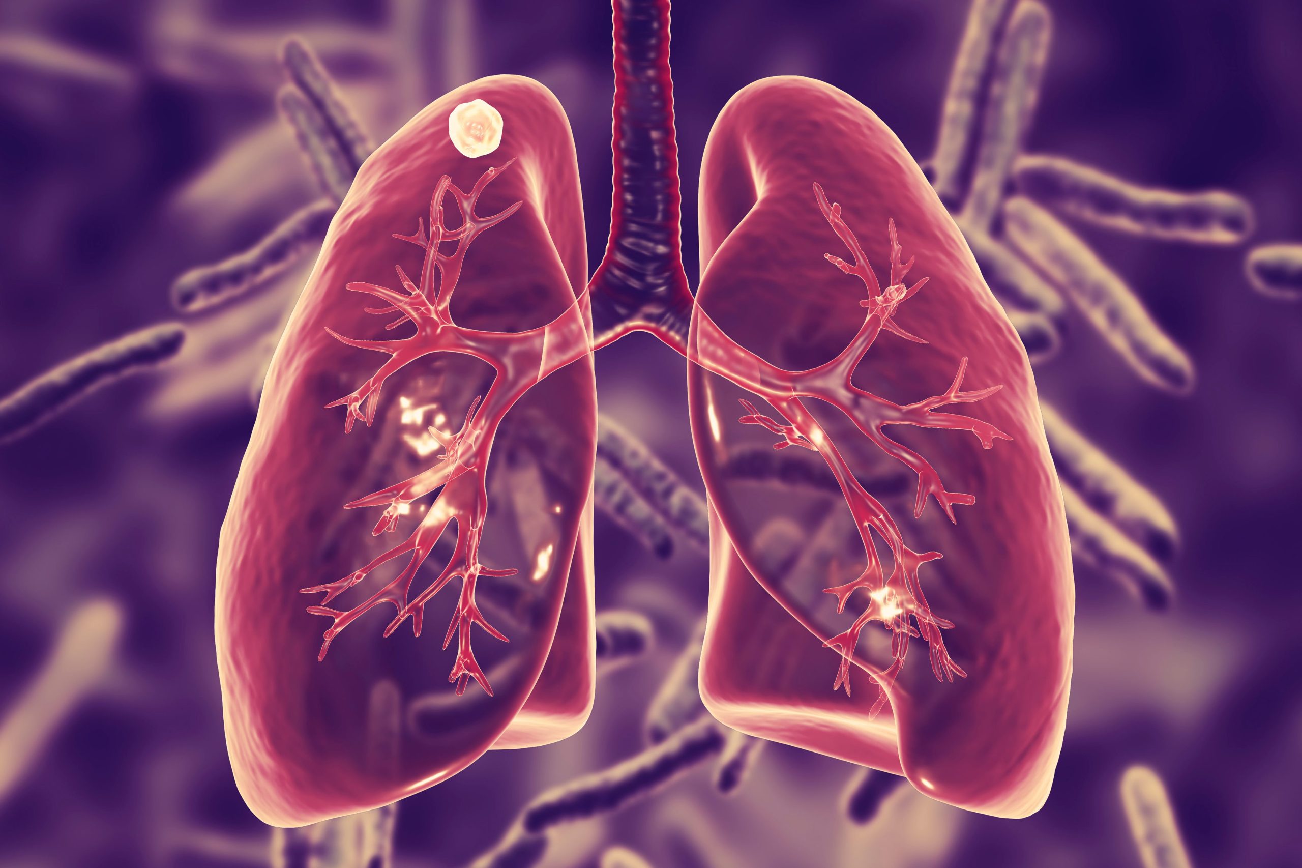 Compliance to the treatment can cure Tuberculosis