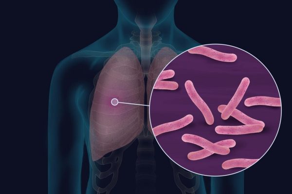 Compliance to the treatment can cure Tuberculosis
