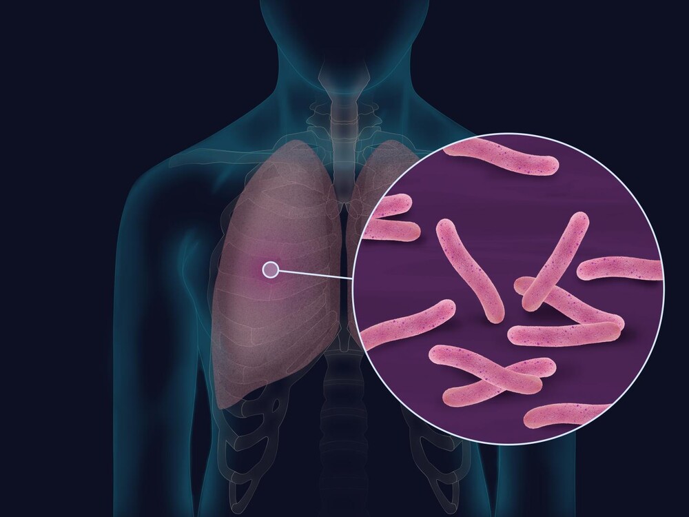 Compliance to the treatment can cure Tuberculosis