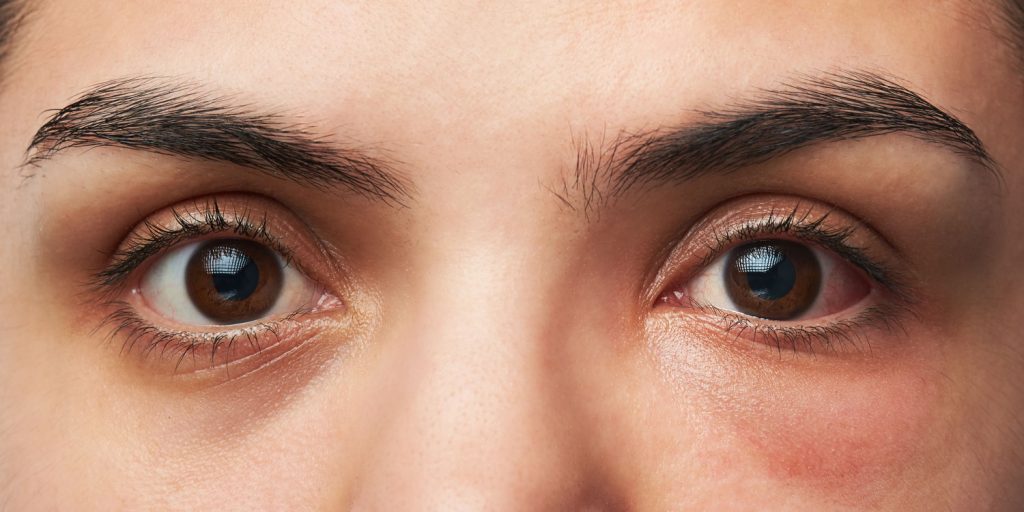 Common Eye Problems
