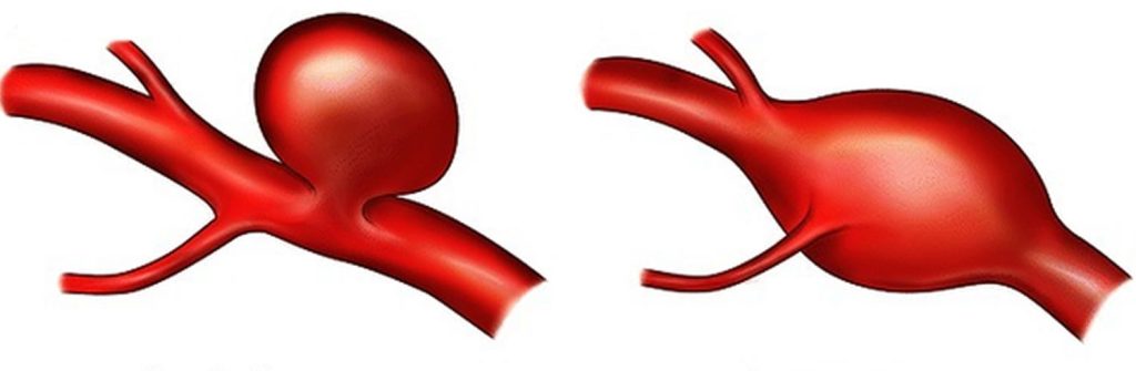 برین اینیوریزم کی اقسام-شفانیوز