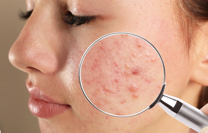 ایکنی کیوں ہوتی ہے؟