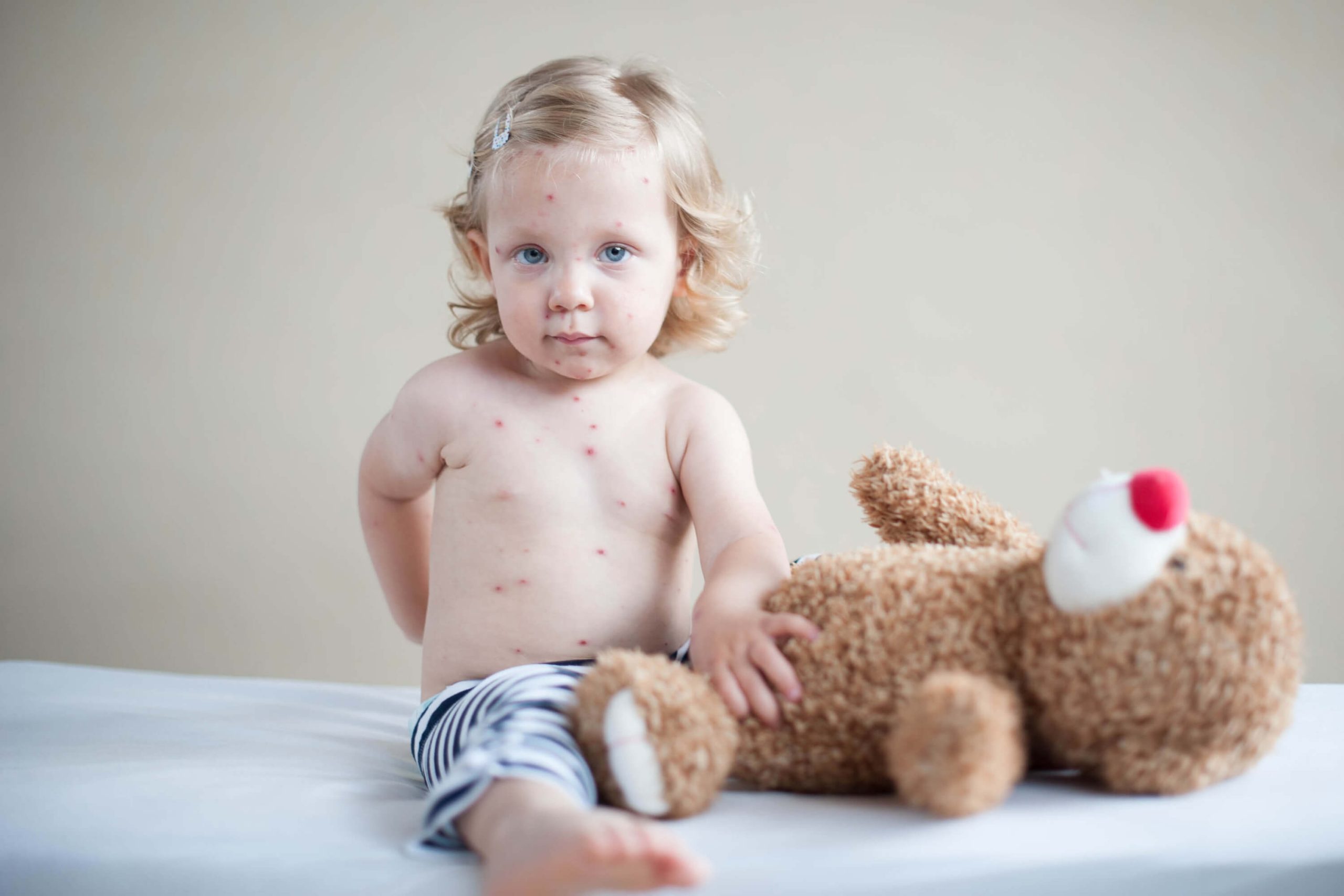 Chickenpox in children