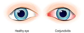 healthy-eye-versus-conjuctivitis-sni