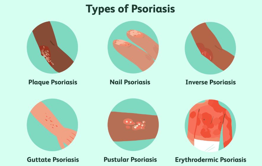 چنبل کی اقسام