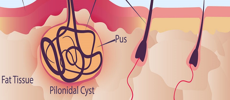 پائلونائیڈل سائی نس سرجری-شفانیوز 