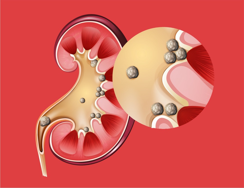 گردوں میں کیلشیم آگزلیٹ کی پتھری