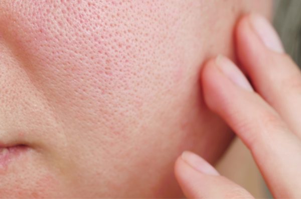 How to treat open pores