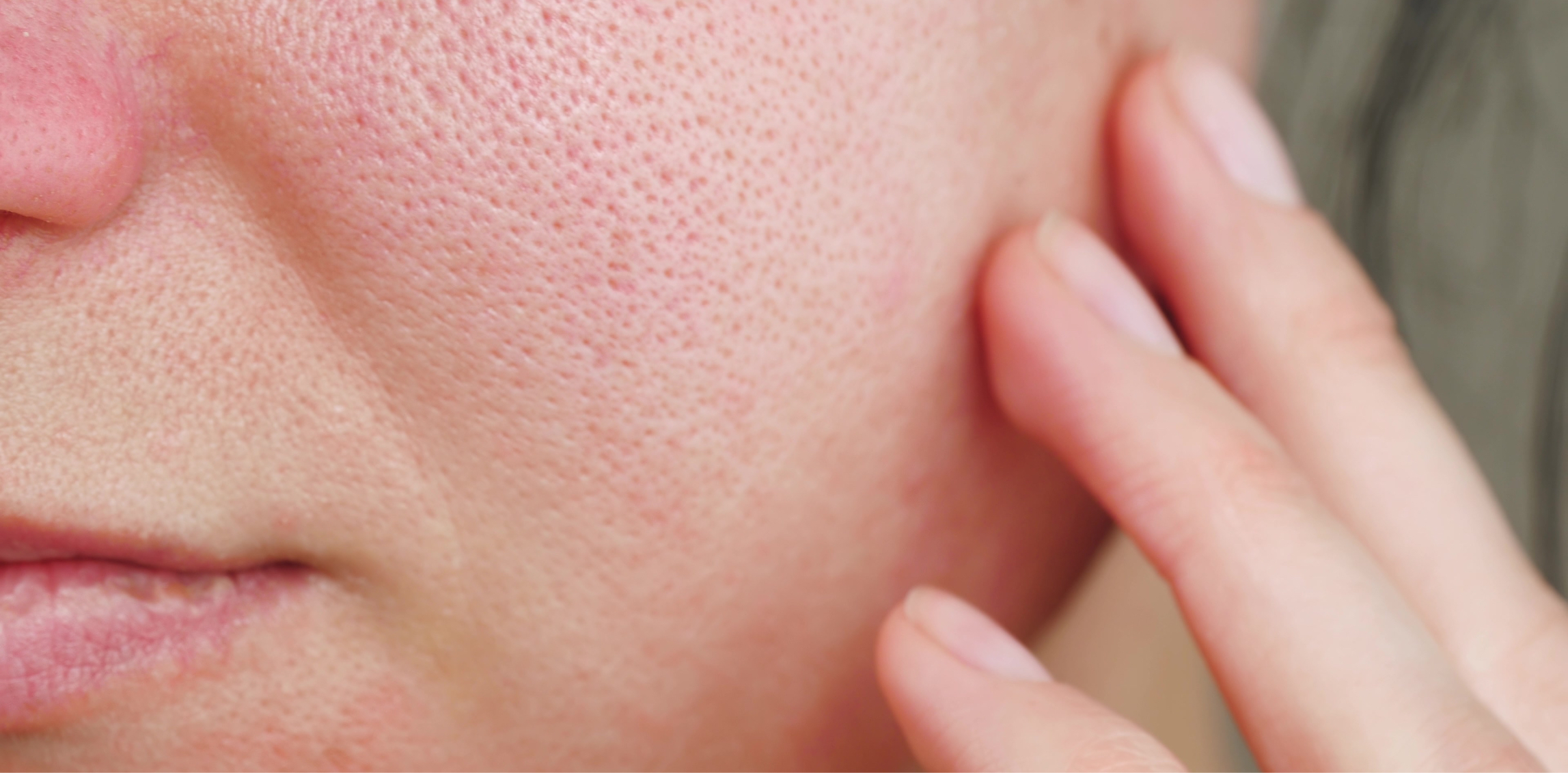 How to treat open pores