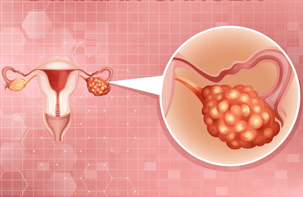اوویرین کینسر-شفانیوز