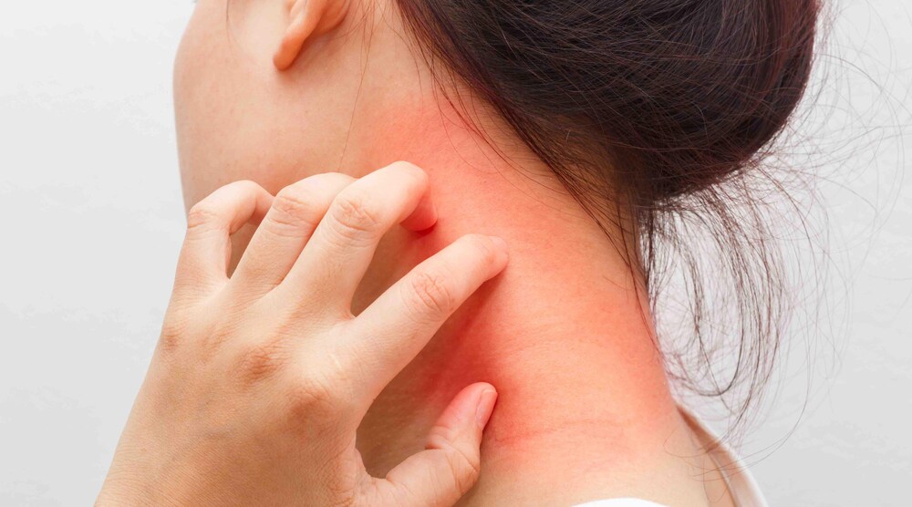 ڈرماٹائٹس-شفانیوز