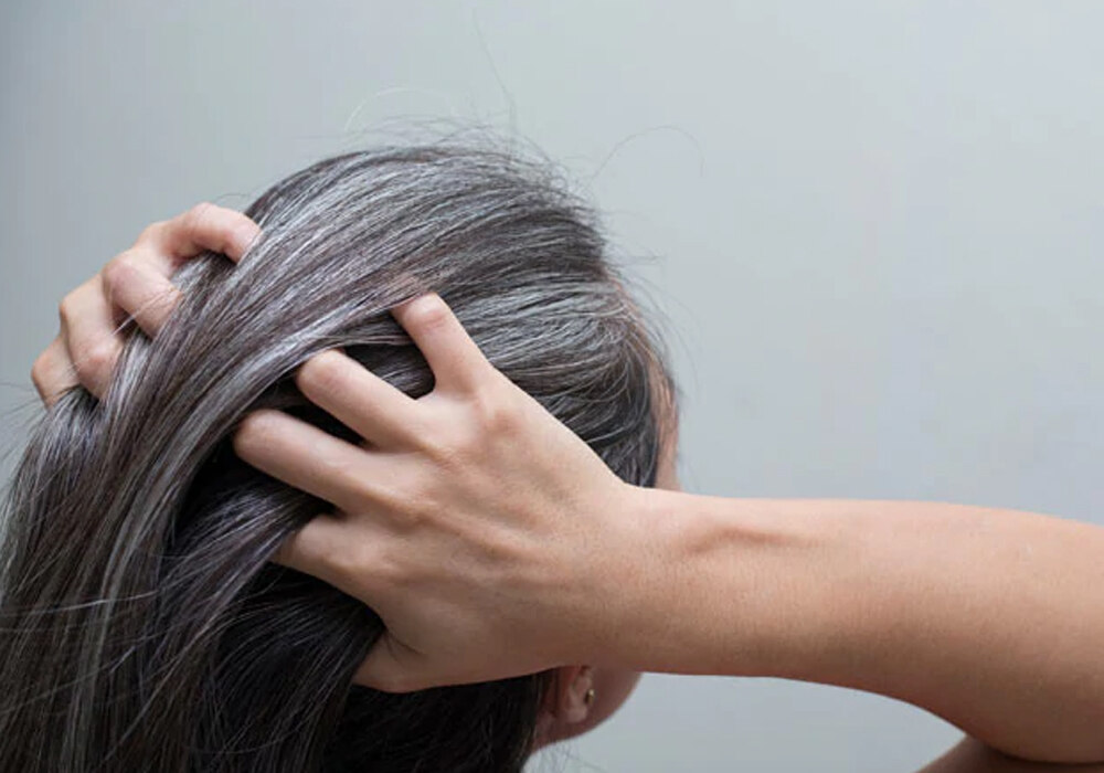Premature graying of hair-shifanews