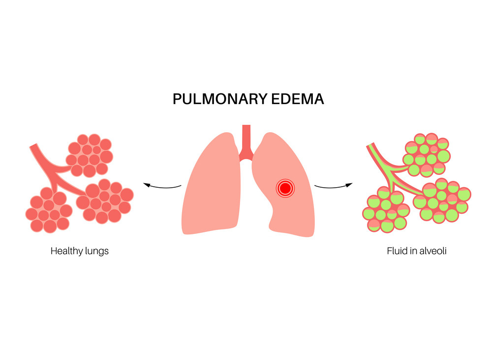 پھیپھڑوں میں پانی-شفانیوز