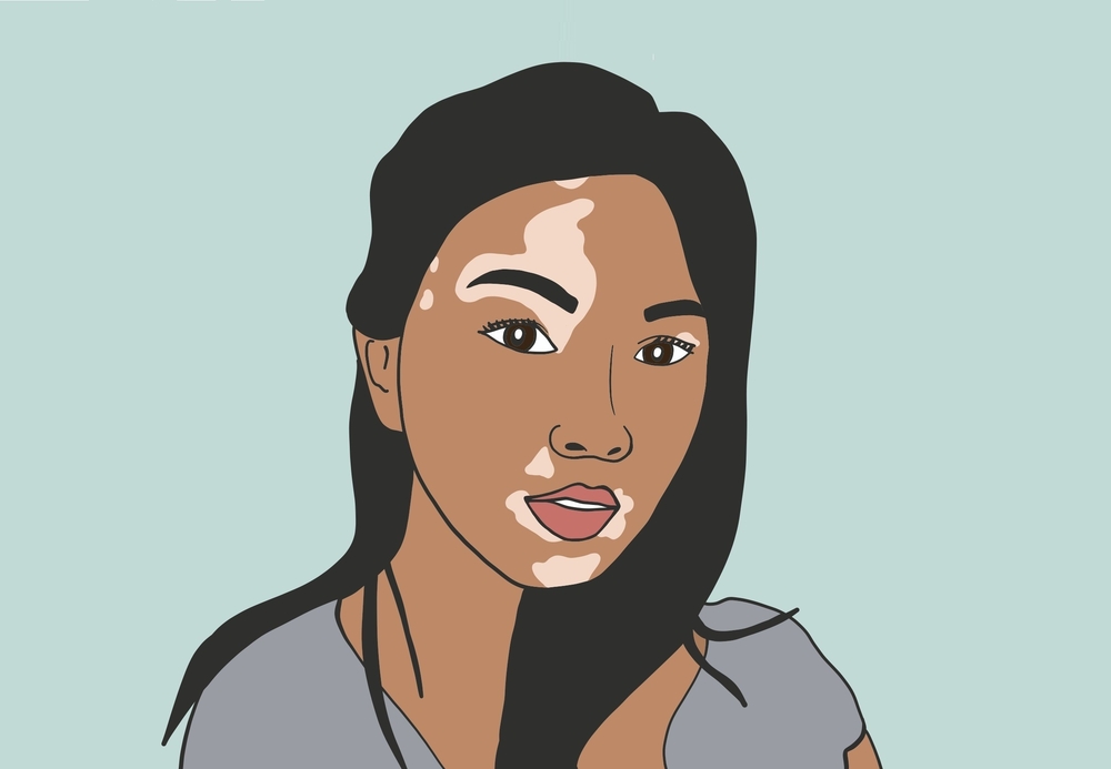 پھلبہری یا برص کیسی بیماری ہے