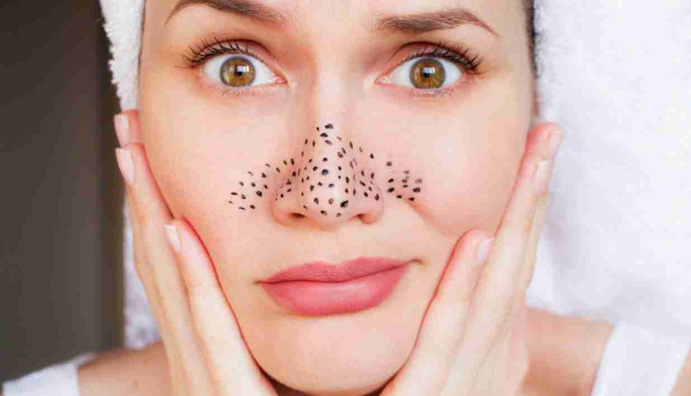 کیل مہاسے کیوں بنتے ہیں