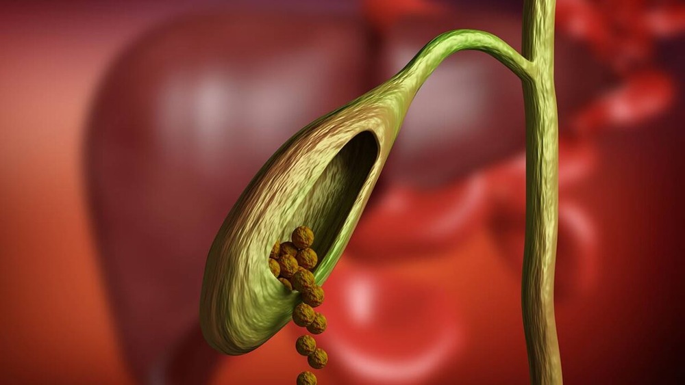 پتے میں پتھری-شفانیوز