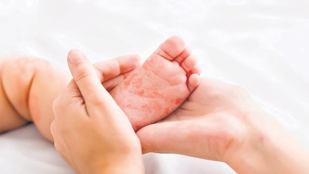 خسرہ سے مرنے والے بچوں کی تعداد 14 ہوگئی – شفا نیوز