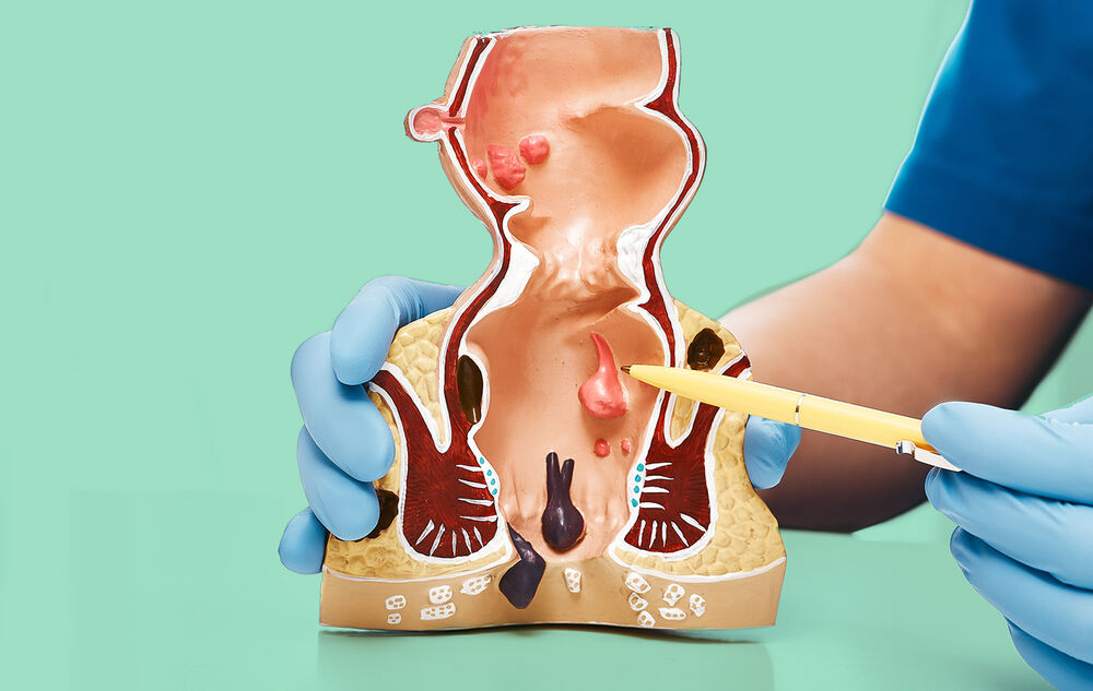 بواسیر-شفانیوز