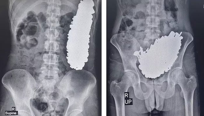 ڈاکٹروں نے مریض کے معدے سے 452 دھاتی اشیاء نکال لیں۔ شفا نیوز