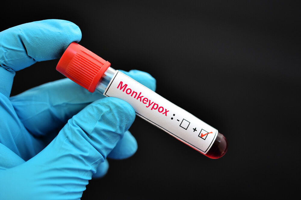 منکی پاکس، پاکستان میں بھی الرٹ جاری