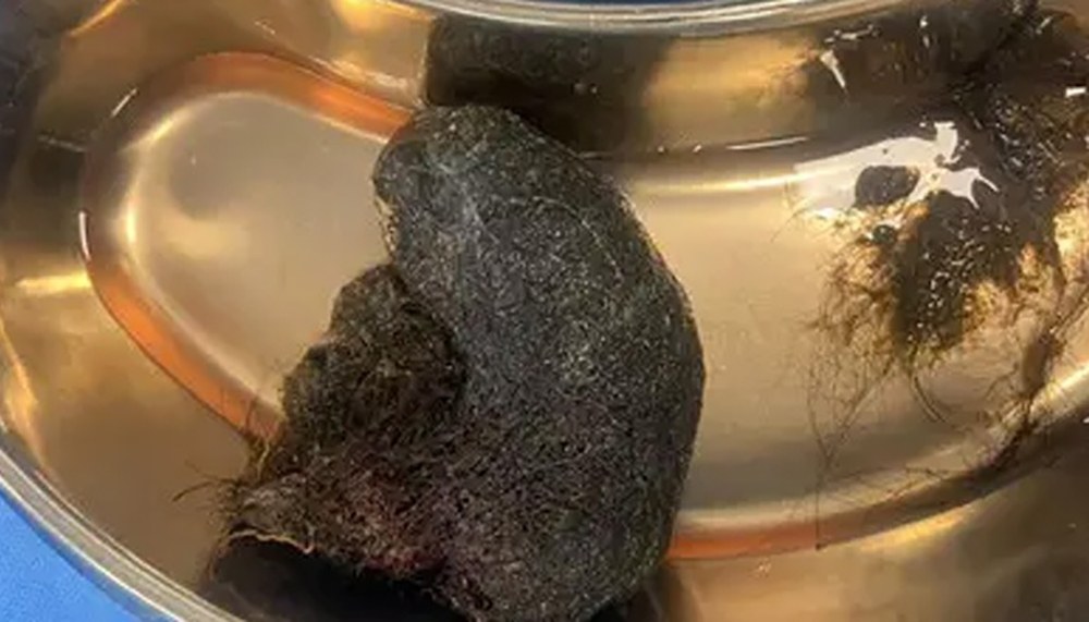 آٹھ سالہ بچی کے پیٹ سے بالوں کا گچھا برآمد- شفا نیوز