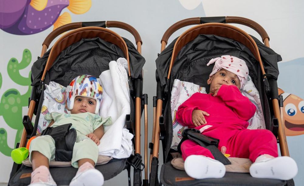 پاکستانی بچیوں کے جڑے سر علیحدہ کرنے کا کامیاب آپریشن- شفا نیوز