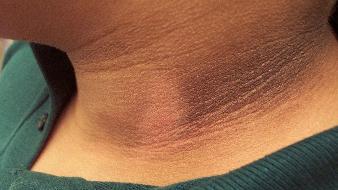 اکینتھوسس نائیگرکینز- شفا نیوز