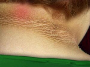 اکینتھوسس نائیگرکنز - شفا نیوز