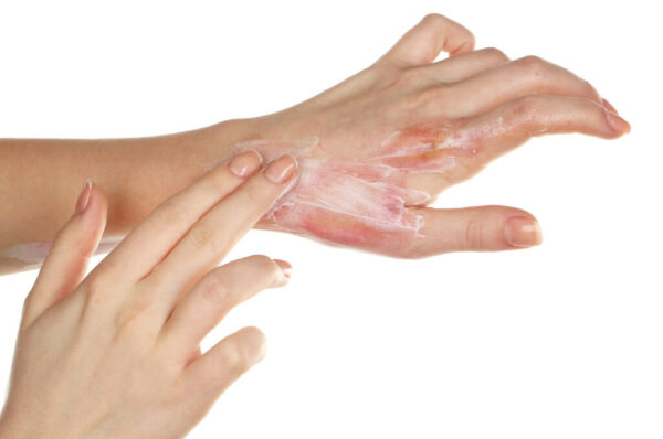 First aid for hot water burns