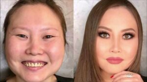 ایکرومیگالی- شفا نیوز