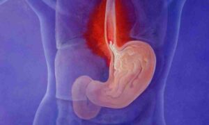 گیسٹرو ایسوفیجیل ریفلکس ڈیزیز- شفا نیوز