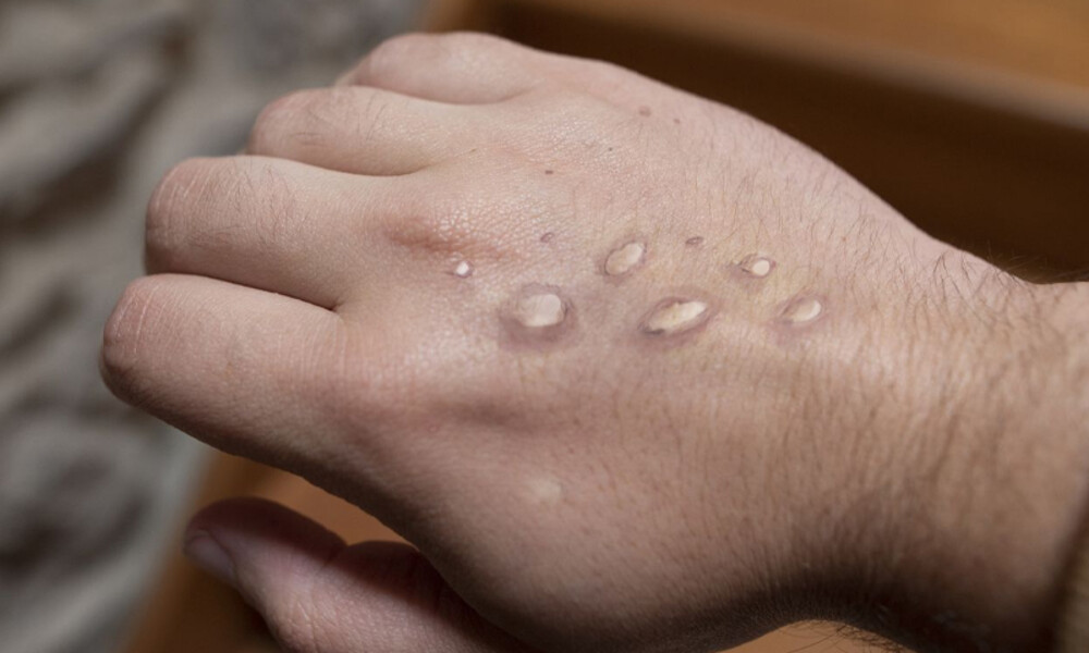 پاکستان میں ایم پاکس کا 8واں کیس رپورٹ