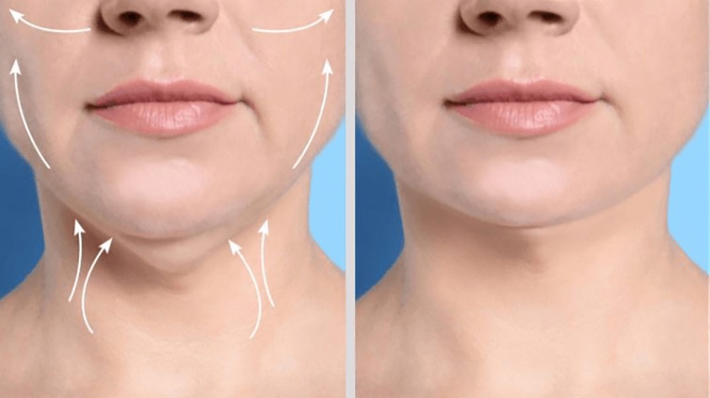 ویٹ لاس میڈیسن سے کاسمیٹک سرجری کی مقبولیت میں اضافہ- شفا نیوز