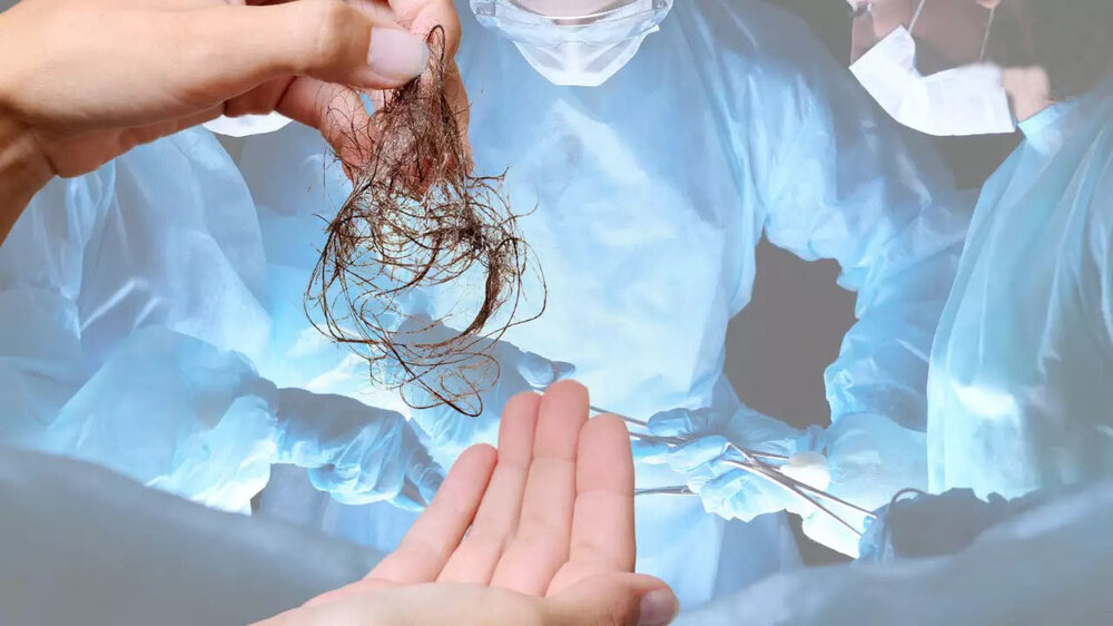 نو سالہ بچی کے پیٹ میں ایک کلو بالوں کا گچھا- شفا نیوز