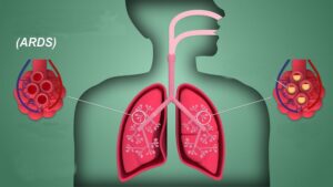 اے آر ڈی ایس - شفا نیوز