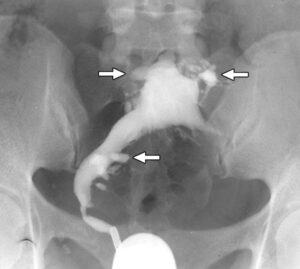 ایڈینومائیوسس: بچہ دانی کی عضلاتی دیوار میں اندرونی تہہ کا پھیلاؤ- شفانیوز