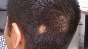 الوپیشیا: بال جھڑنے کا مسئلہ - شفا نیوز