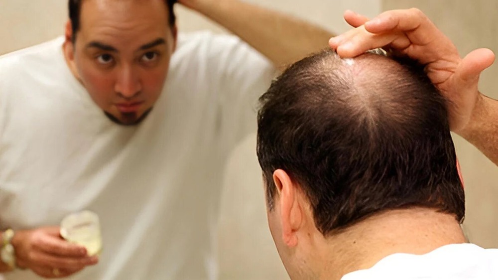 الوپیشیا: بال جھڑنے کا مسئلہ - شفا نیوز