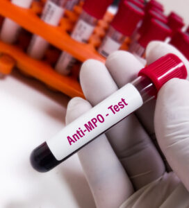 چرگ-اسٹراوس سنڈروم: خون کی نالیوں کی سوزش- شفا نیوز